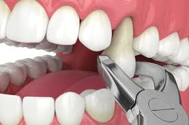 দাঁত তোলা - Azam's Dental Care